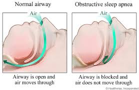 obstructive sleep apnea image
